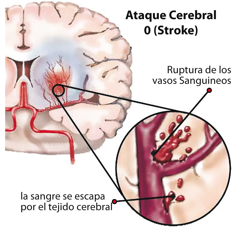stroke-reportemedico