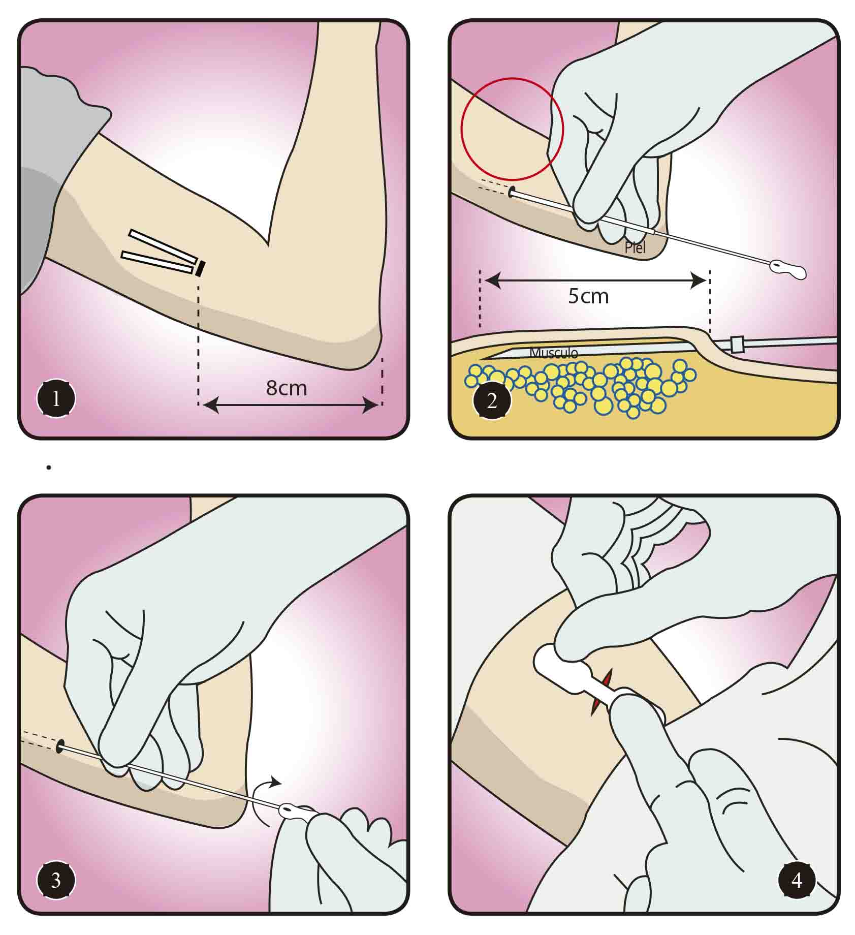 procedimiento-implante-reportemedico